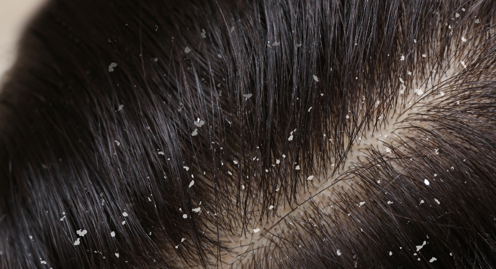 Daily Hair Care Routine to Prevent Dandruff