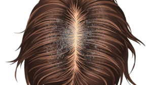 Can Treating Dandruff Improve Hair Growth
